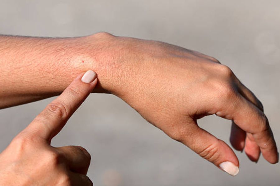 A bee sting on a woman's wrist.